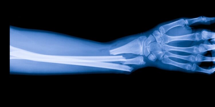 Handheld ‘bone printer’ offers new approach to healing fractures